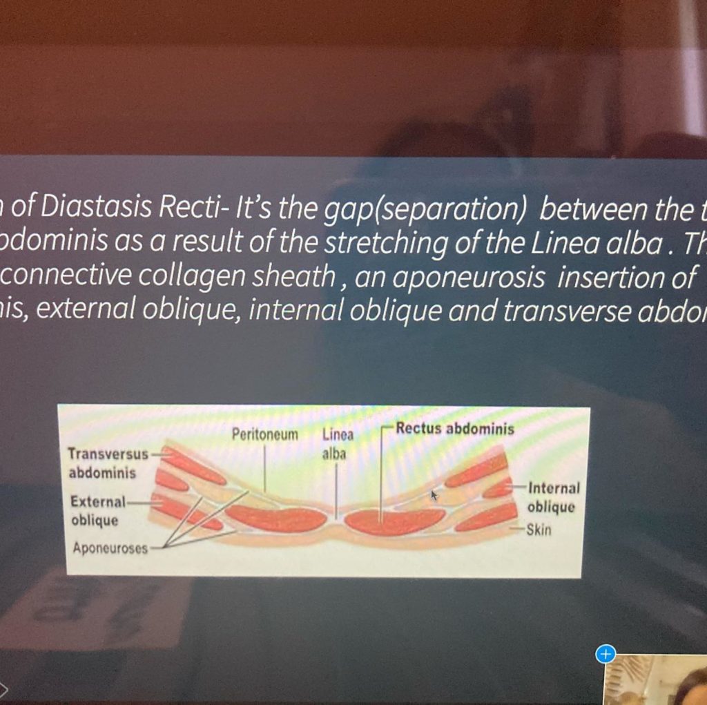 Diastasis Recti Uncovered