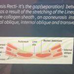 Diastasis Recti Uncovered