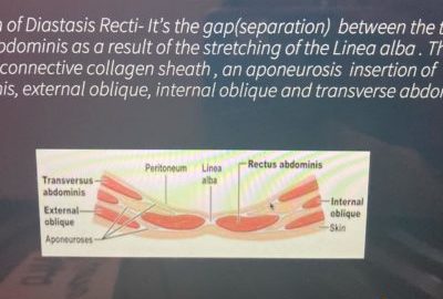 Diastasis Recti Uncovered